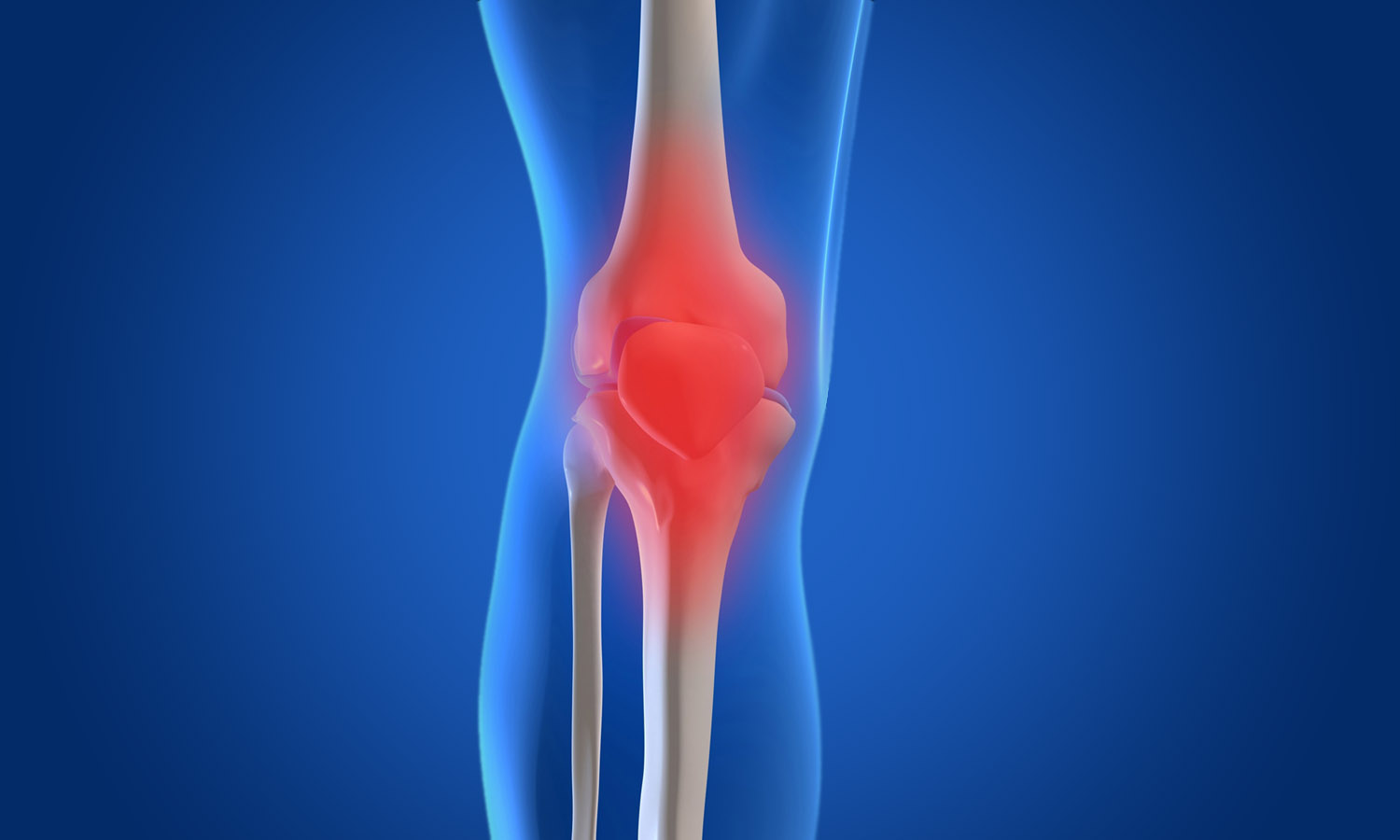 Остеоартроз это. Синовит коленного сустава. Бурсит коленного сустава рентген. Остеоартрит и остеоартроз.